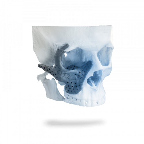 Patient Specific Implants-min