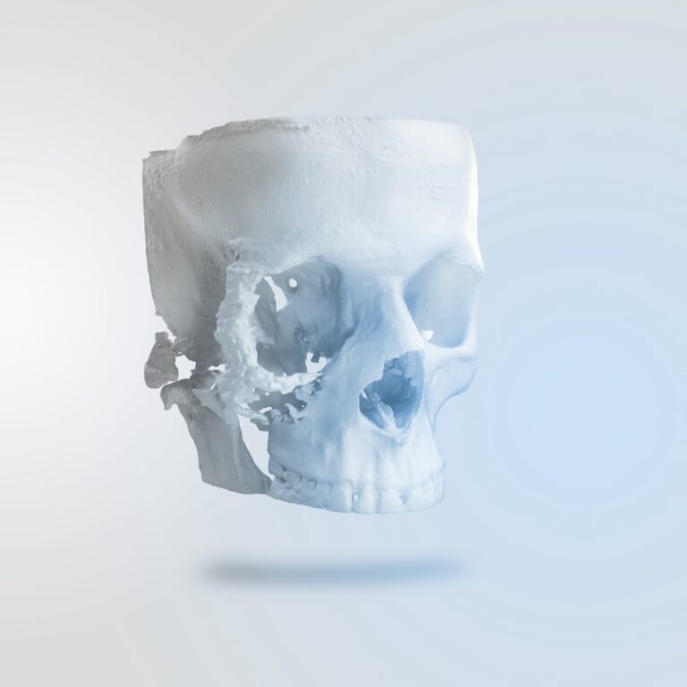 p2-Patient Specific Implants (1)-min