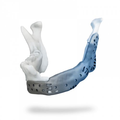 Patient Specific Implants3-min