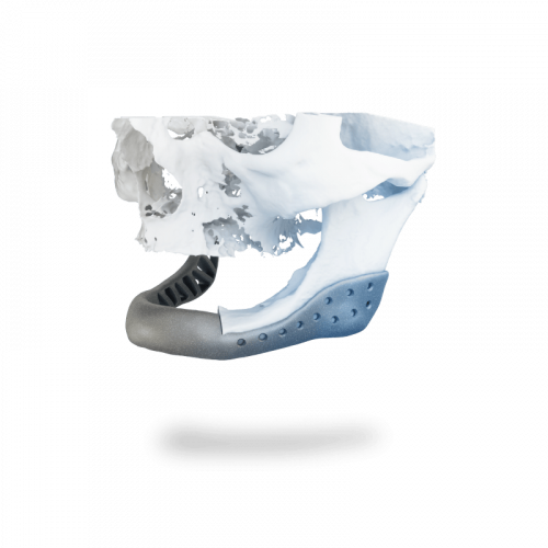 Patient Specific Implants (2)-min