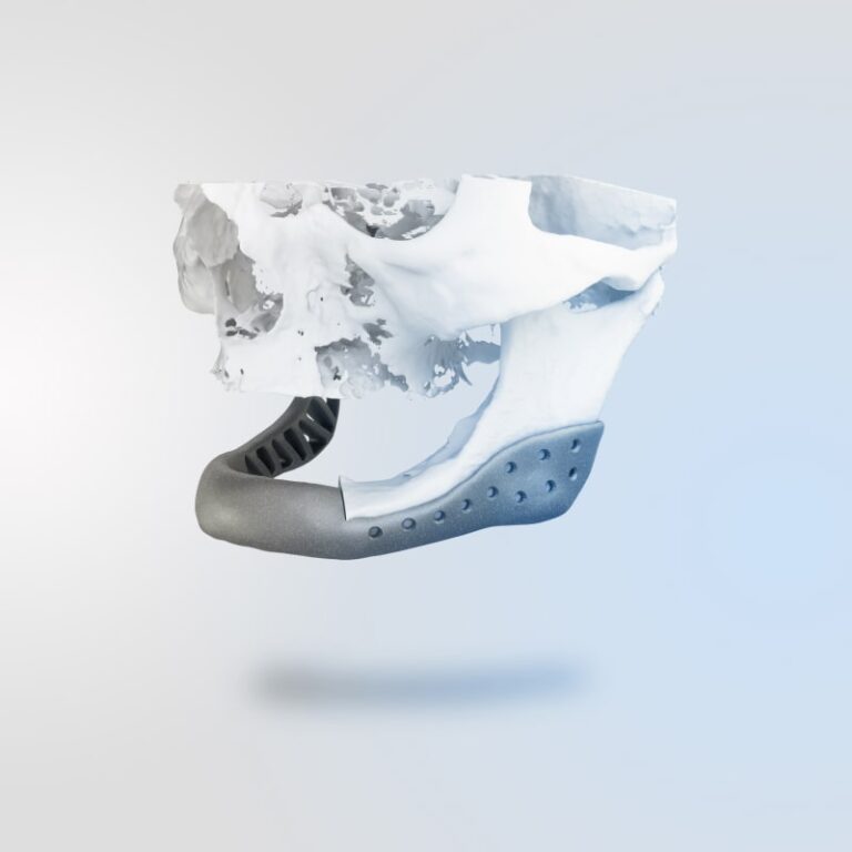 Patient Specific Implants (2)-min