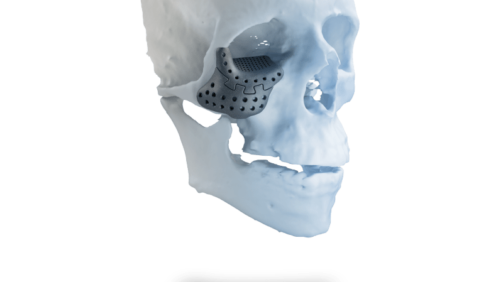 Patient Specific Implants-project2 (1)