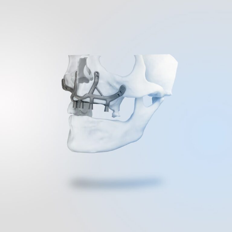 Subperiosteal Implant-project (1)-min