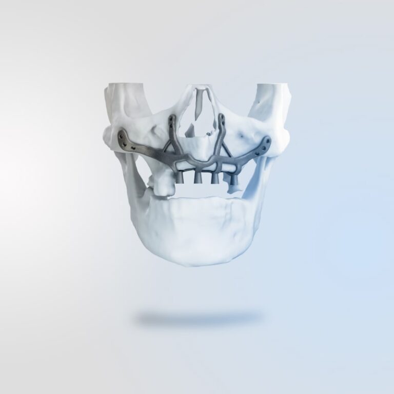Subperiosteal Implant-project (3)-min