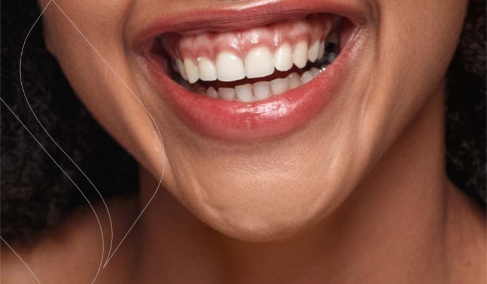 لبخند لثه ای چیست؟