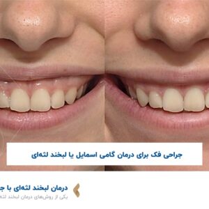 درمان لبخند لثه ای با جراحی فک