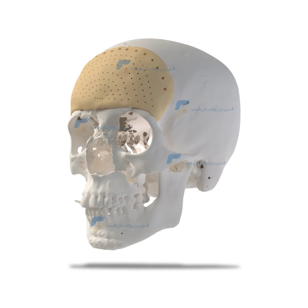 ایمپلنت های سفارشی سه بعدی