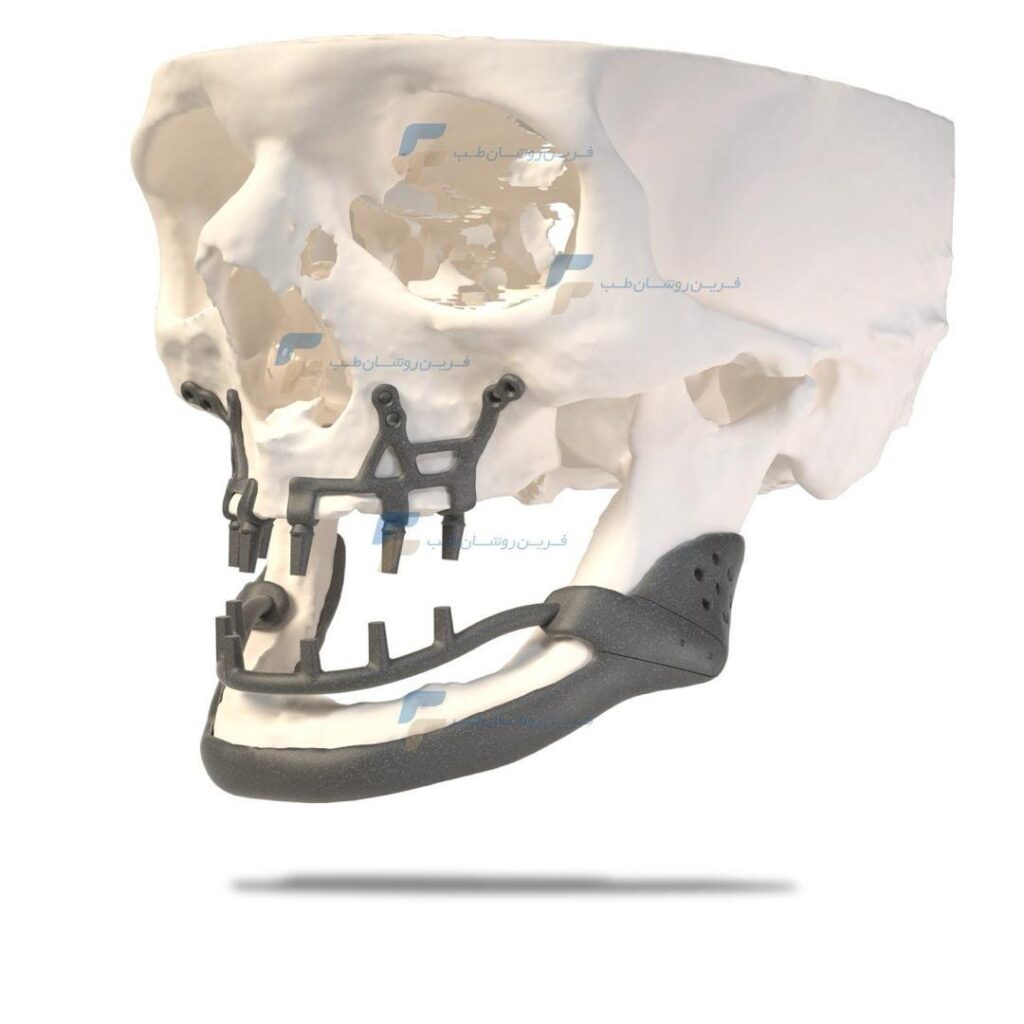 ایمپلنت‌ ساب پریوستئال سفارشی