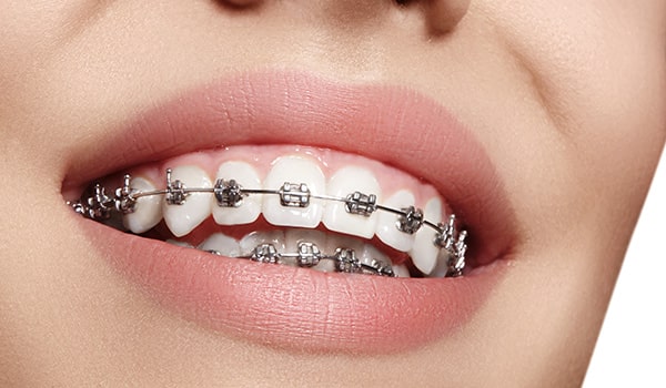 ارتودنسی دندان چیست و چه انواعی دارد