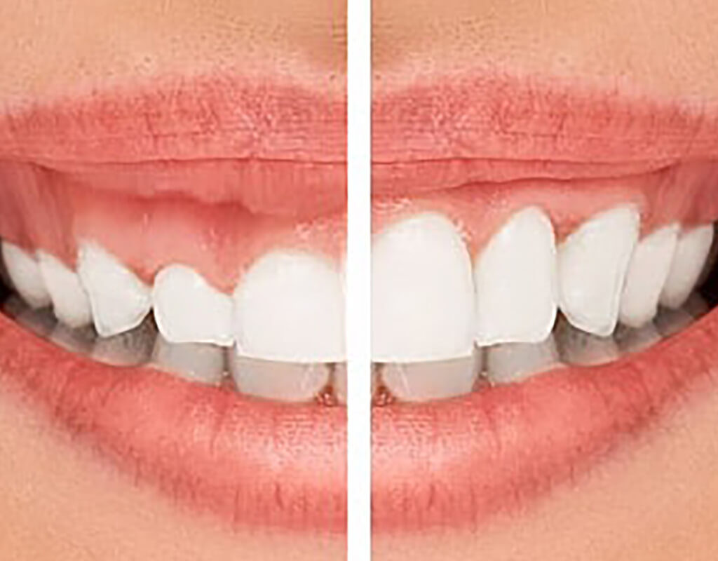 لبخند لثه ای چیست