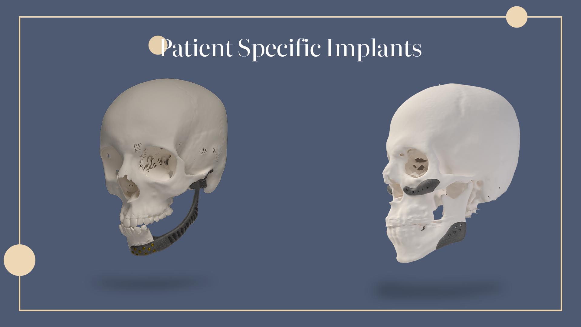 10 اشتباه رایج در استفاده از ایمپلنت‌های شخصی سازی شده