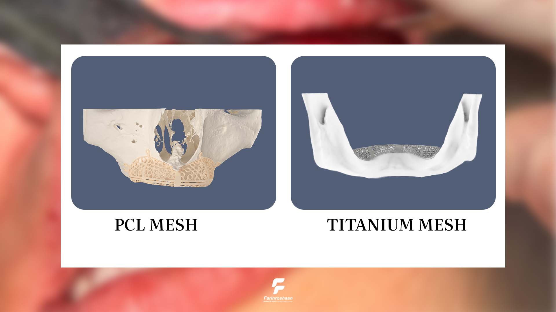 مش کاستومایز با مش‌های آماده