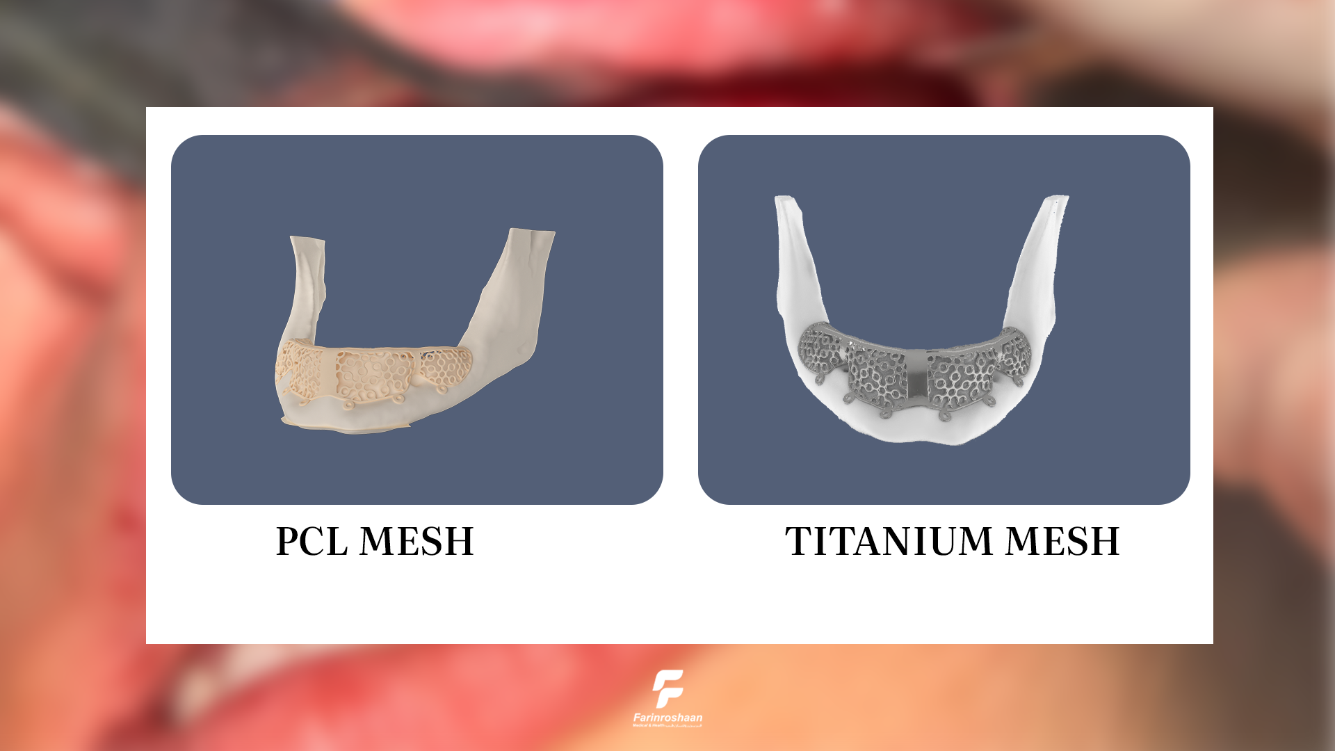 تفاوت مش جذبی و تیتانیومی