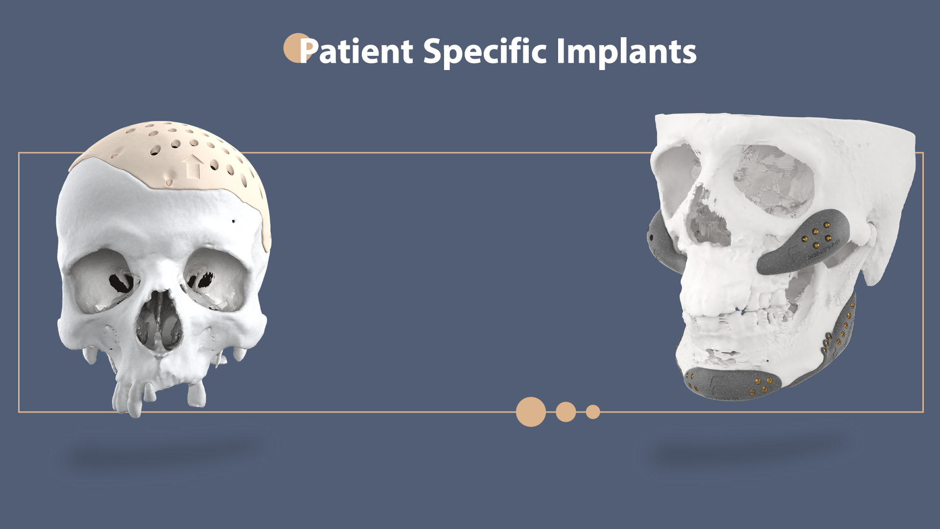 طراحی مبتنی بر کنترل ریسک در ایمپلنت‌های شخصی‌سازی‌شده