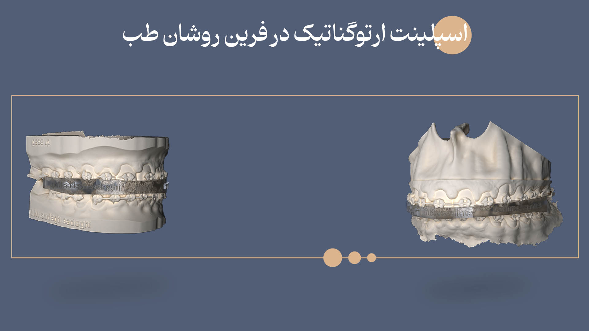 اسپلینت اکلوزال