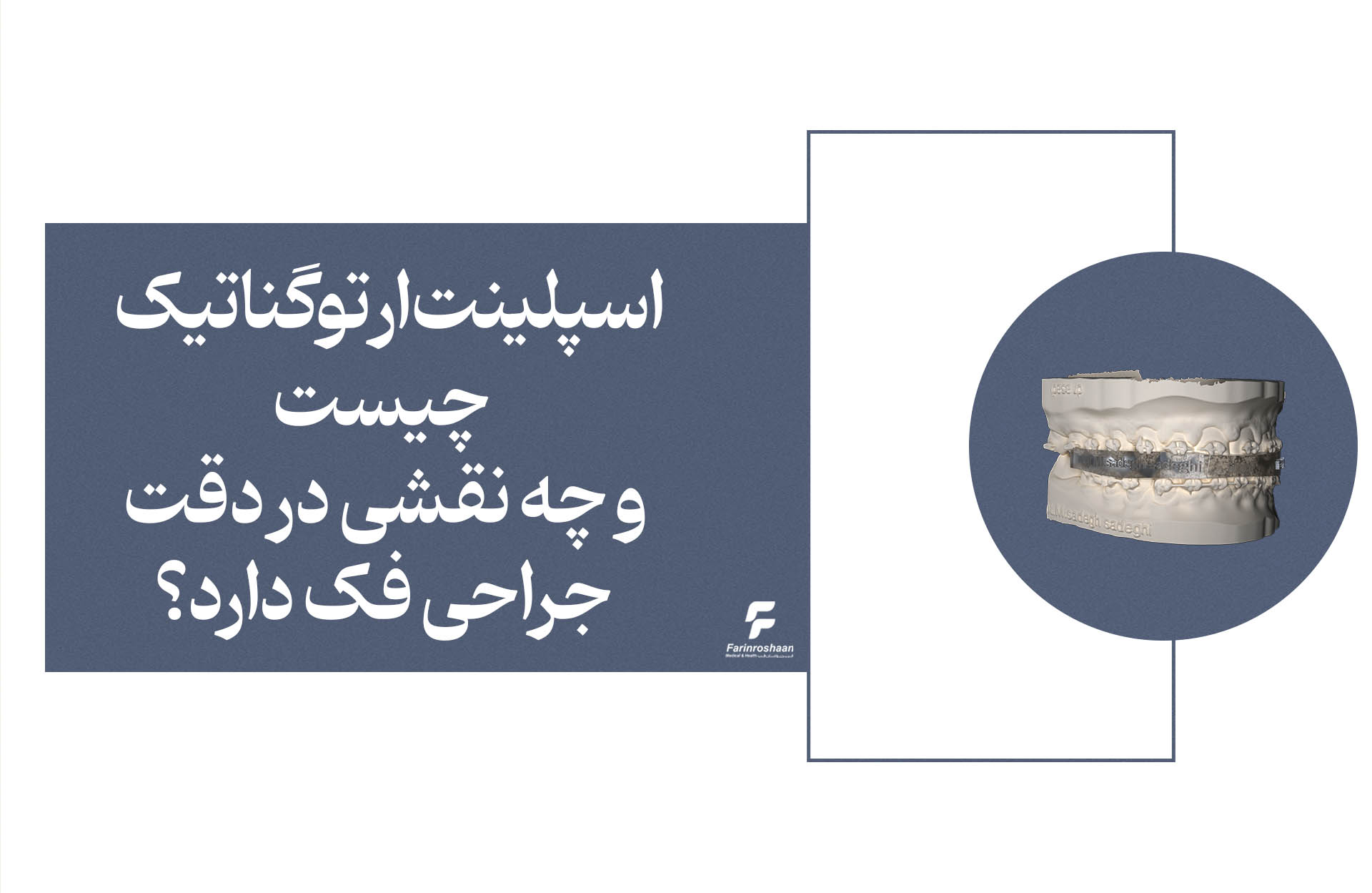 اسپلینت ارتوگناتیک