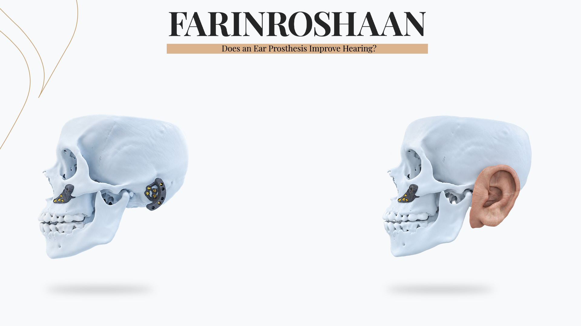 Does an Ear Prosthesis Improve Hearing?